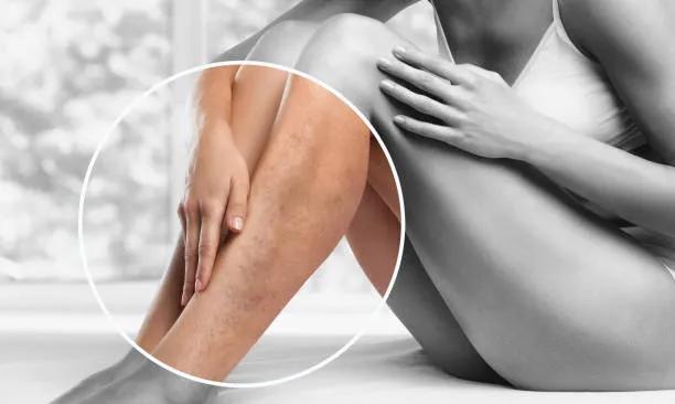 Does Sclerotherapy Improve Leg Appearance?