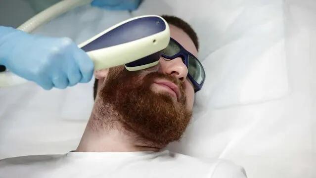 Does Beard Laser Hair Removal Work on Thick Hair?
