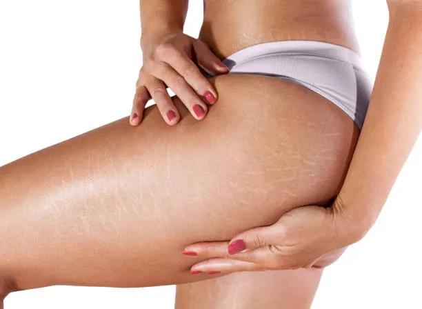 Can Stretch Mark Removal Improve Skin Texture?