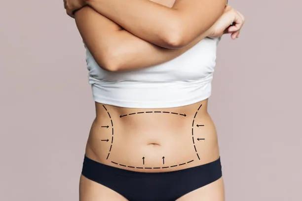 How Lipo Abdominoplasty Shapes the Waistline ?