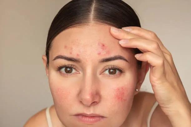 Is Acne Treatment Suitable for Darker Skin Tones?