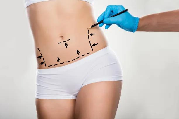 Can Tummy Tuck Reshape Waistline?