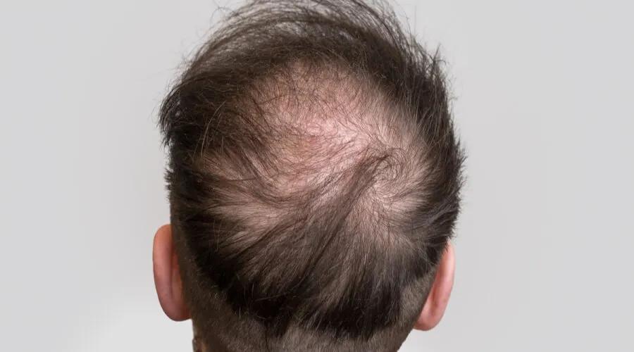 Does Crown Hair Transplant Treat Advanced Baldness?