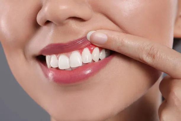 How to Prepare for Gum Recession Treatment ?