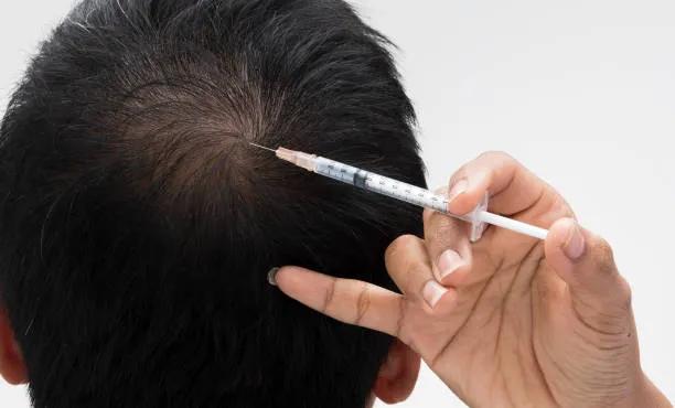 Can Stem Cell Hair Transplant Treat Alopecia?