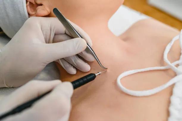 Is Mole Removal a Permanent Solution?