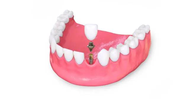 What Makes Dental Implants So Popular?