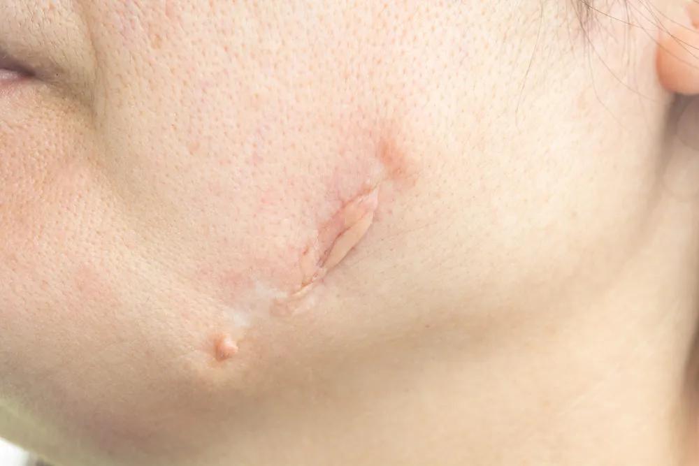 Does Facial Scar Revision Improve Skin Texture?