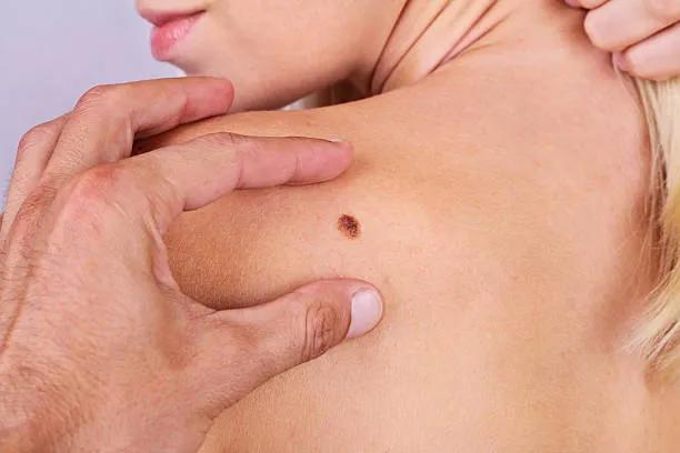 Which Areas Are Treated in Skin Tag Removal ?