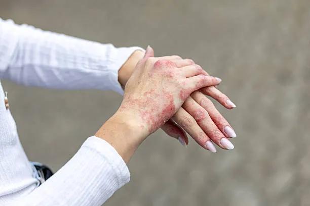 Can Eczema Treatment Stop Skin Peeling?