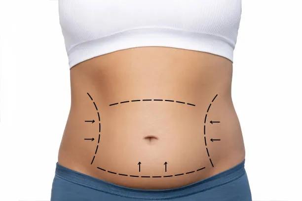 Is Liposuction Helpful for Lower Belly Fat?