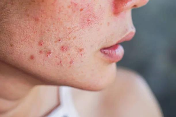 Can Acne Treatment Clear Pores and Blackheads?