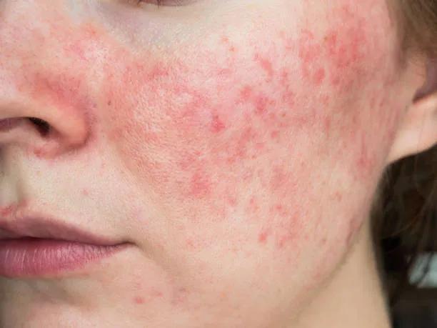 Can Laser Acne Scar Treatment Fade Dark Acne Spots?