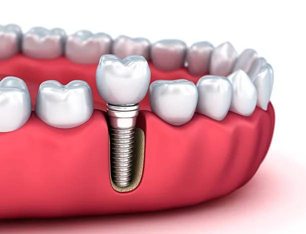 How Do Dental Implants Restore Bite Strength?
