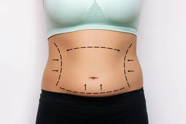 Can Liposuction Improve Body Confidence Quickly?