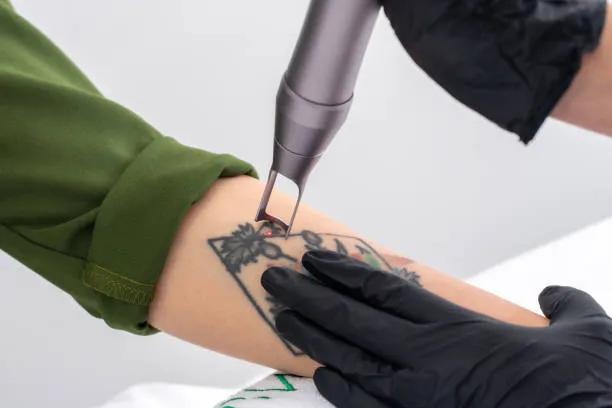 Is Laser Tattoo Removal Effective for Large Tattoos?