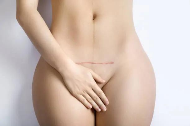 Does Hoodplasty Require Follow-Up Visits?