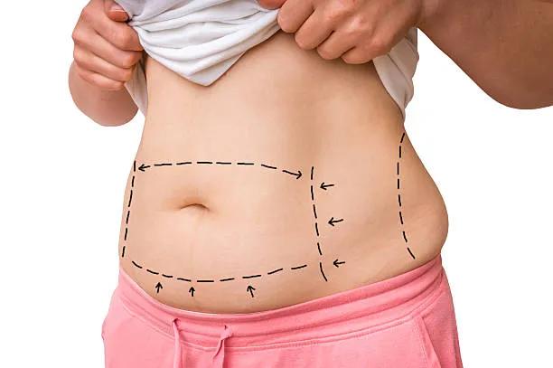 How Does Liposuction Target Stubborn Fat Cells?