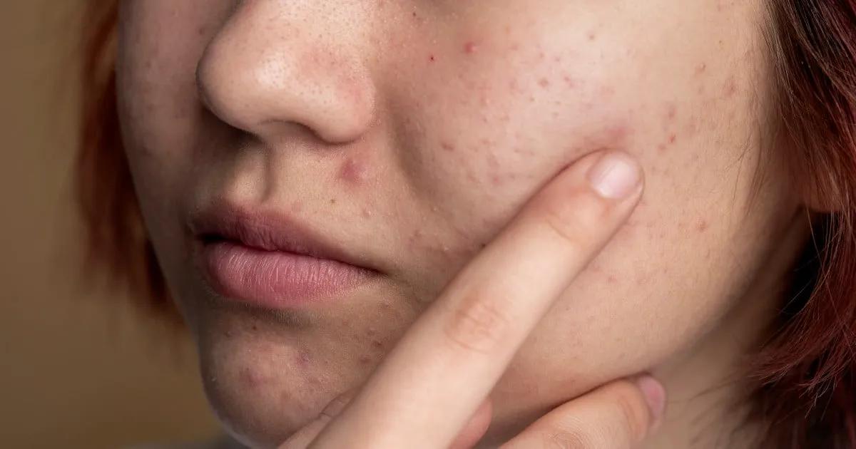 Can Acne Treatment Clear Skin Permanently?