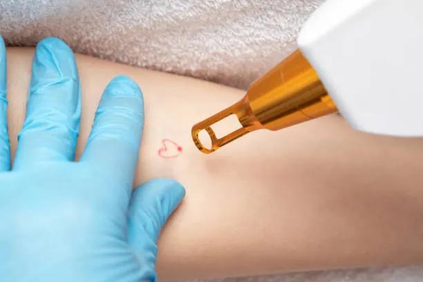 Can Laser Tattoo Removal Treat Patchy Tattoos?