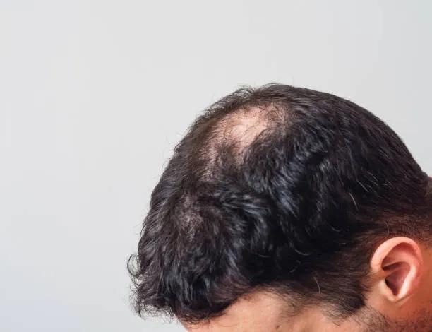 Can Hair Loss Treatment improve weak hair roots?