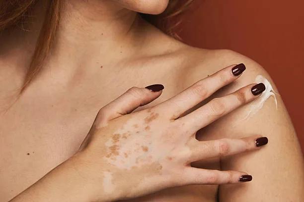 Can sensitive skin handle vitiligo treatment ?