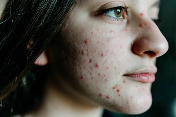 Can Acne Treatment improve skin hydration balance?
