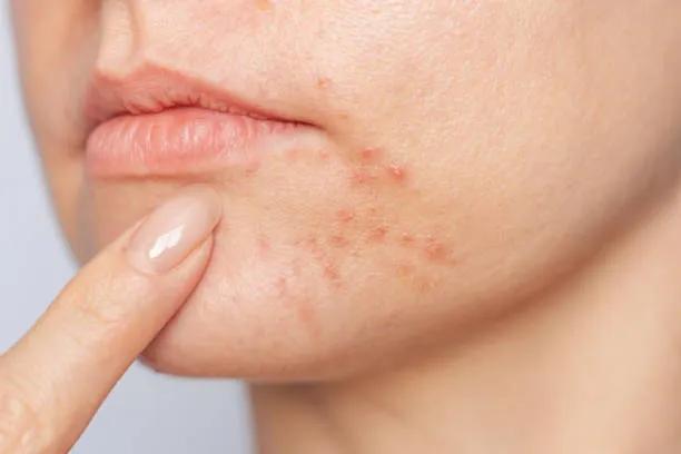 Is Laser Acne Scar Treatment Good for Deep Pores?
