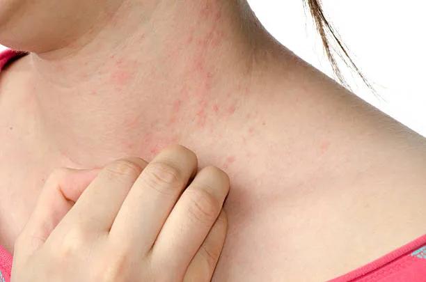 Can Eczema Treatment Minimize Skin Scarring?