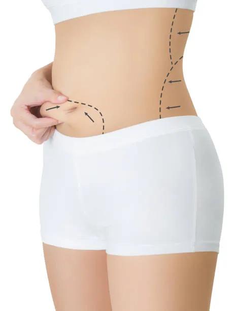 Is Liposuction Effective for Lower Belly Pouch?