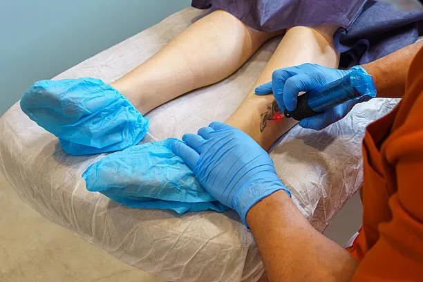 Can Tattoo Removal Help Restore Natural Skin Tone?
