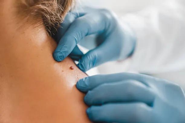 How Quickly Does Wart Removal Deliver Clear Skin?