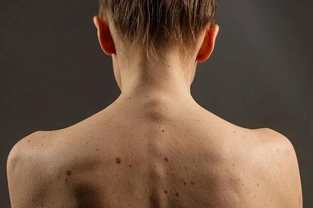 Can Skin Tag Removal Eliminate Tags in One Session?