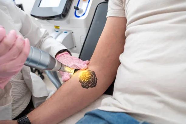 Can Laser Tattoo Removal Treat Stubborn Tattoos?