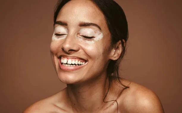 Is Vitiligo treatment suitable for every age?