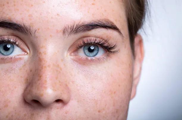How Does Eyelid Surgery Address Under-Eye Fat Deposits?