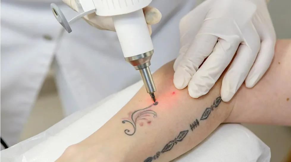 Can Laser Tattoo Removal Remove Regretful Tattoos?
