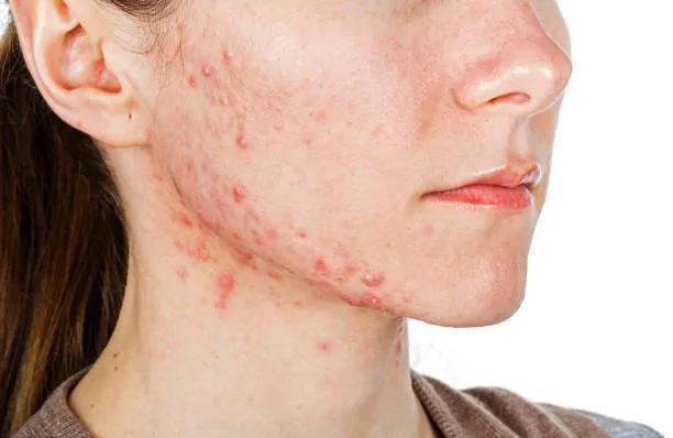 Can Acne Treatment Reduce Post-Acne Blemishes?