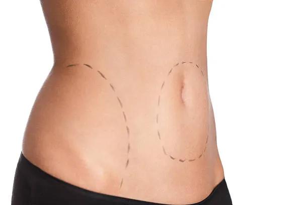 Can Tummy Tuck Help Achieve a Firmer Abdomen?