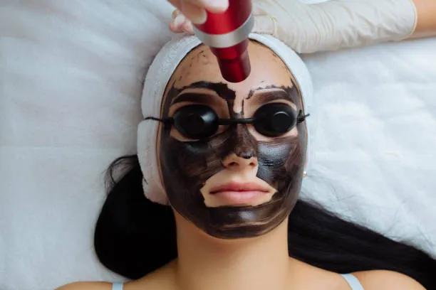Does Laser Carbon Peel Help Prevent Future Breakouts?